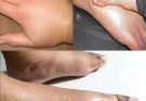 Get Rid of Swollen Hands & Feet Fast: Home Remedies for Water Retention
