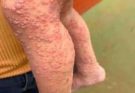 His whole body was itchy, he thought it was an allergy and was diagnosed…See more