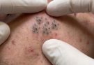 The Spectrum of Acne Lesions